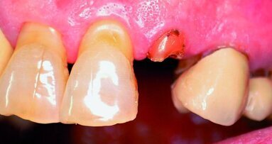 Facteurs de réussite de l’implantation immédiate avec mise en charge immédiate -  Une étude de cas