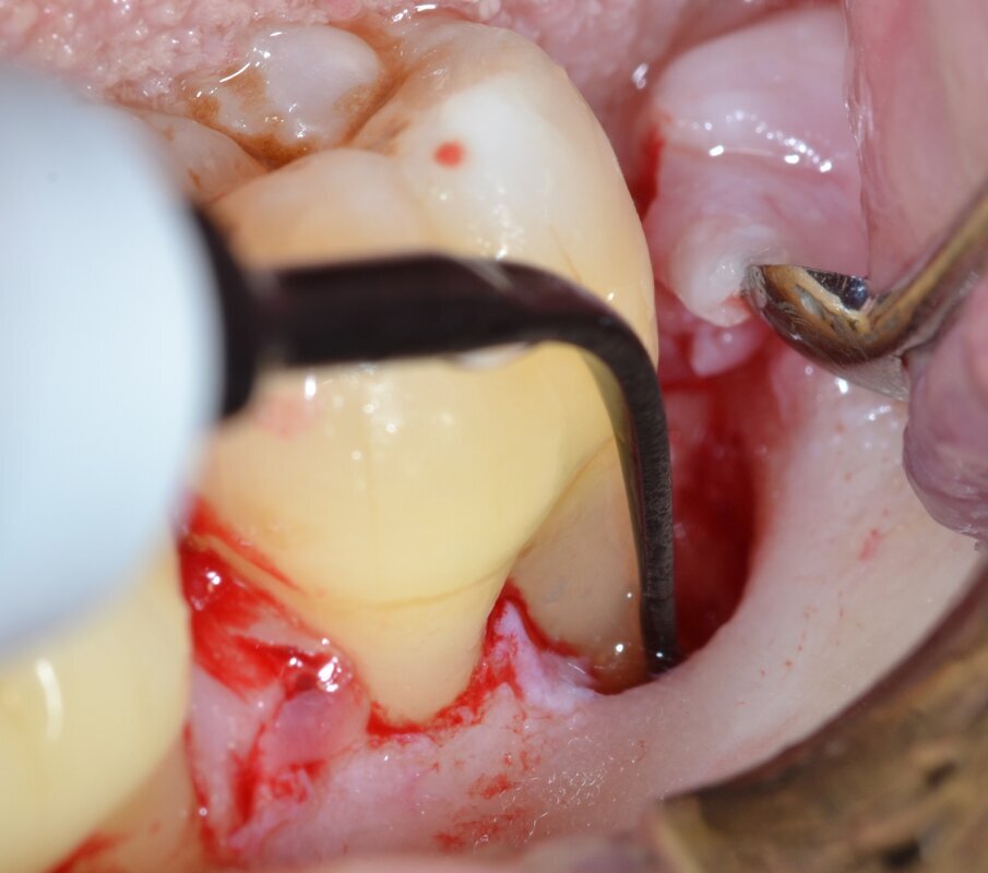Fig. 6 - Debridement del difetto intraosseo e decontaminazione della superficie radicolare mediante ultrasuoni (aspetto buccale).