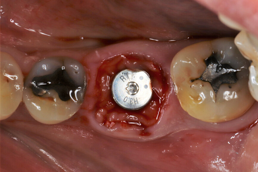 Fig. 15: Implant in final position with A-PRF protecting the bone substitute granules.
