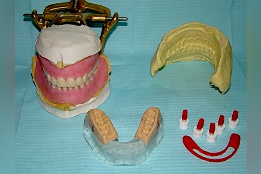 Fig. 30. Todo lo necesario previo a la cirugía y colocación de los implantes dentales: encerado diagnóstico, prueba estética, guía quirúrgica, guías de mordida, postes de impresión modificados, Guía vestibular de Putty, barra de Duralay® OSU.