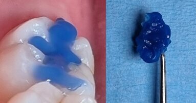 The stamp technique: Quick and effective restoration with glass hybrids