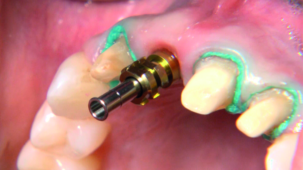 Immediate implantation and full-ceramic restoration in the maxillary anterior region