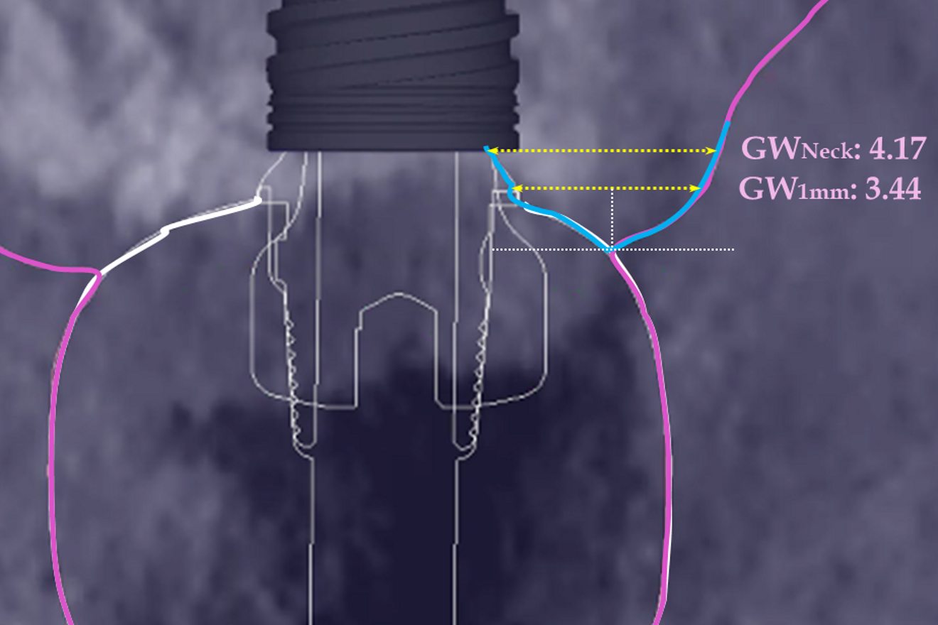 Fig. 7f: GW at prosthesis delivery measured at 1 mm from where the sulcus begins (GW1mm) and at the level of the implant neck (GWNeck). Despite a loss of thickness, GW was still above 3 mm.