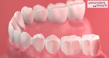 Kiefertransplantat mit 3D-Drucker hergestellt