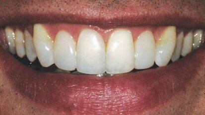 Le collage du banquier : lorsque le moins est un plus