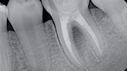 Praktické klinické faktory v reendodontické terapii