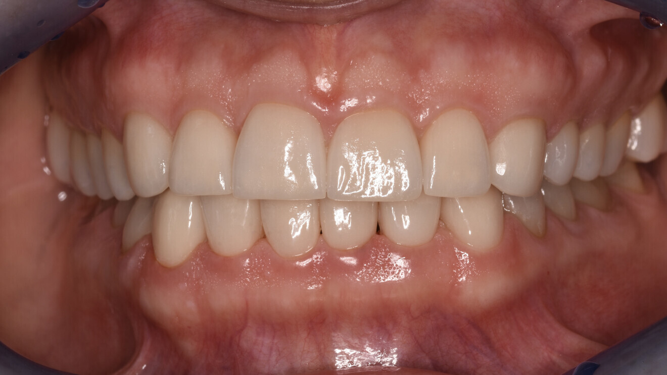 Fig. 13: Final lithium disilicate restorations.