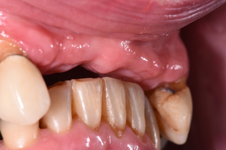 Fig. 2_La mancanza del provvisorio evidenzia parte delle criticità del caso con una dimensione verticale fortemente ridotta. 