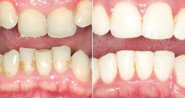 In nur sechs Monaten: Mit Six Month Smile zum perfekten Lächeln