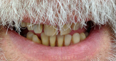 Riabilitazione implanto-protesica post-estrattiva a carico immediato secondo la tecnica All on four: un caso clinico