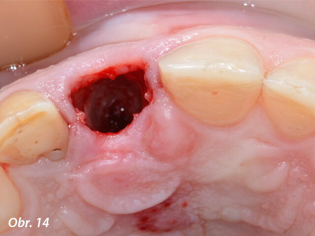 Očištěné lůžko po atraumatické extrakci zubu 11.
