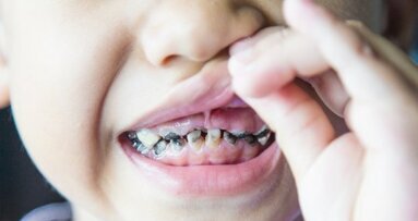 Produženo dojenje povećava rizik za razvoj karijesa