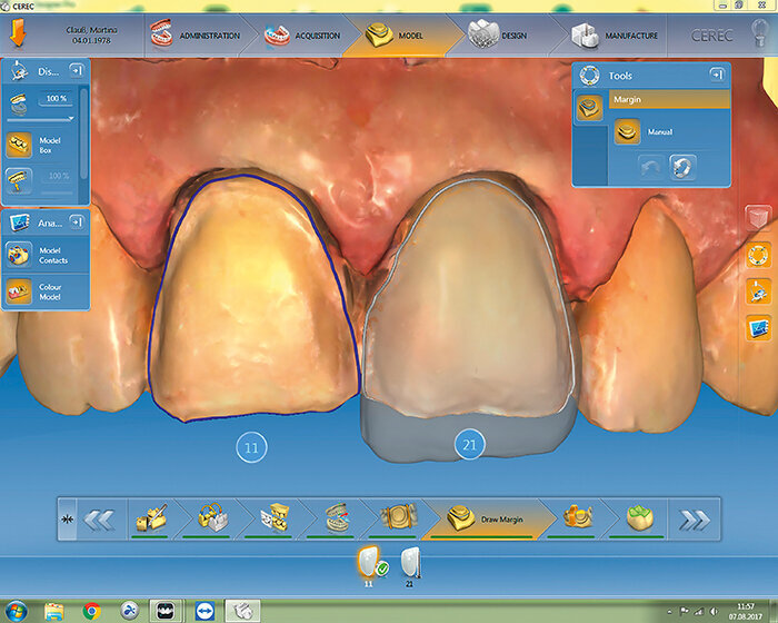 Fig. 7: The design of the hybrid ceramic veneer in the CEREC software.