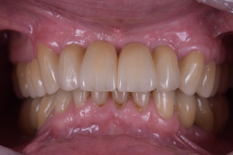 Fig. 46_Anche la cementazione rappresenta un passaggio importante per l’ancoraggio implantare, il controllo di fissazione dei monconi e la corretta rimozione del cemento. 