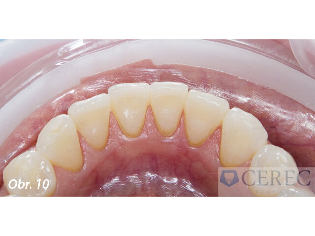 Perfektní adaptace fazet s optimálním okrajovým designem