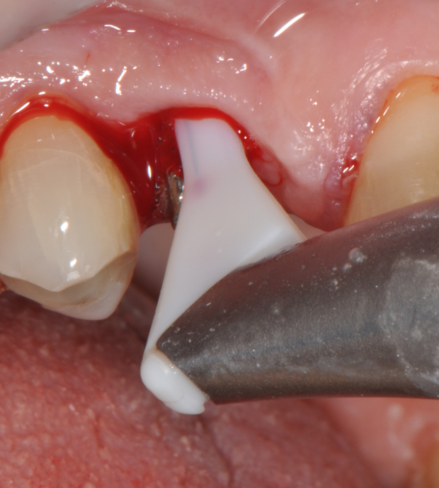 Fig.7: Pocket decontamination with erythritol powder conveyed by sub-gingival tip.