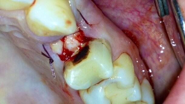 Zastosowanie fibryny bogatopłytkowej (PRF) w stomatologii