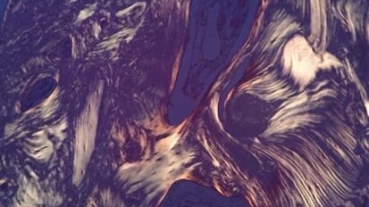 Jednoetapowe hydrokinetyczne podniesienie dna zatoki szczękowej z wykorzystaniem kwasu hialuronowego