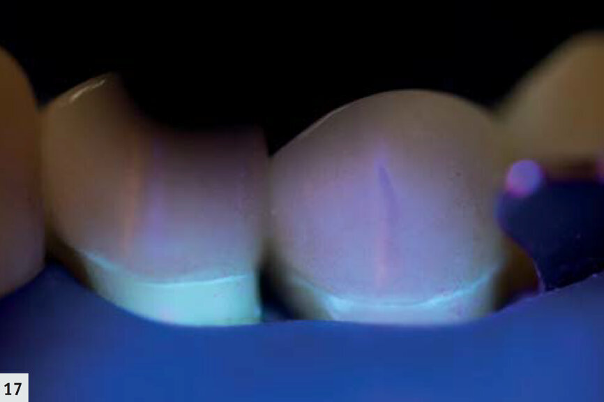 Fig. 17 : Même onlay que sur la Fig. 16, après polymérisation. Seule une très fine ligne correspondant au scellement est visible ; l’absence d’un surplomb est confirmée. 