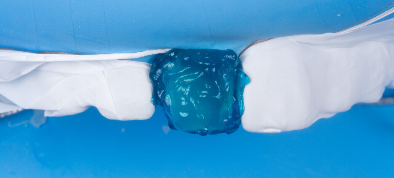 Fig. 16 : Mordançage (Acide orthophosphorique 37 % 20 secondes), rinçage, séchage.