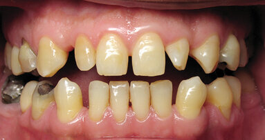 Mock-up: Vaše každodenní pomůcka v estetické stomatologii