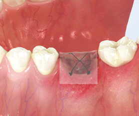 ORA-AID cerotto riassorbibile per il cavo orale