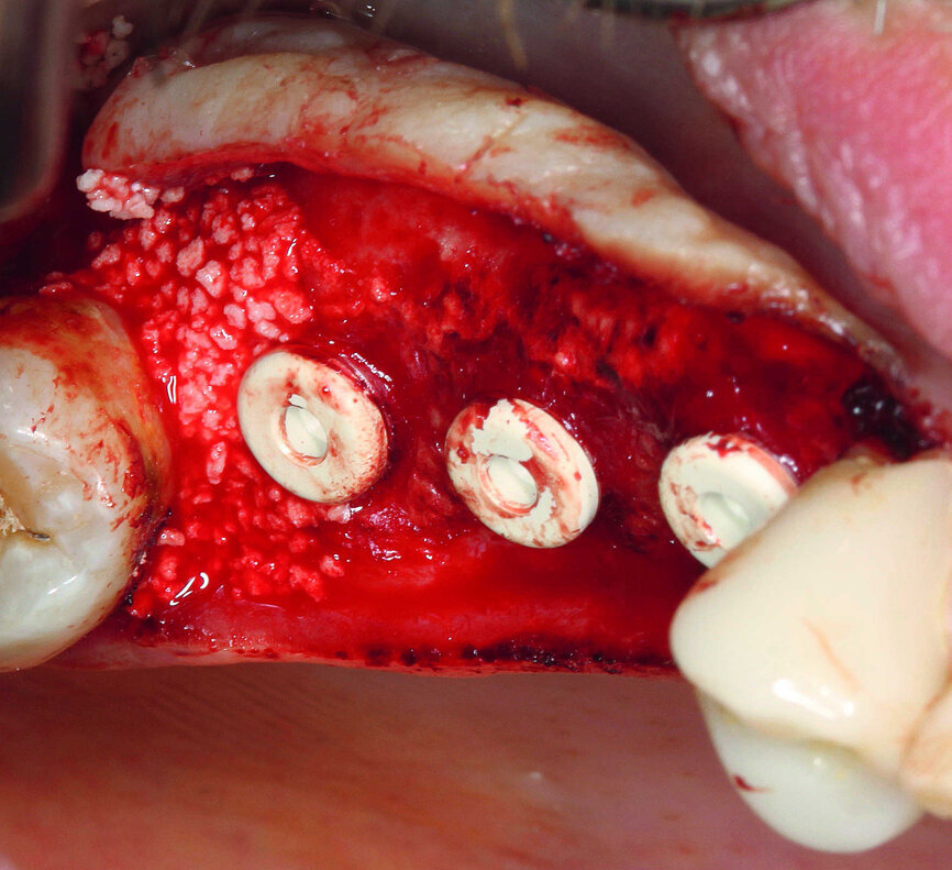 Fig. 15 : Régénération osseuse guidée (ROG) du défaut intra-osseux parodontal. 
