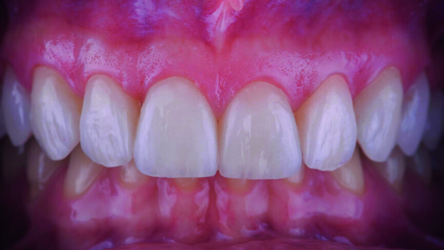 Fig. 17b: Final outcome one week later, frontal view.