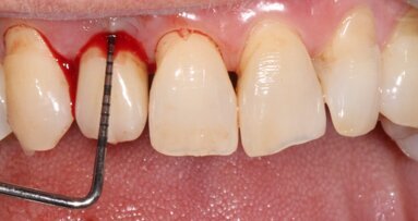 Valutazione dell’efficacia dello spazzolino elettrico Oral-B iO nei pazienti con riabilitazioni implantari fisse