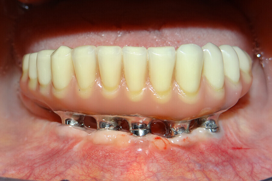 Fig. 8. Rx Pre-operatoria, Prótesis híbrida inmediata con 10 años de evolución y Rx Control a los 10 años.