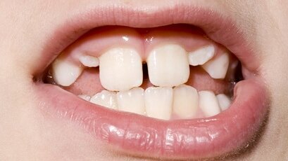 Wady zgryzu trzeba leczyć!