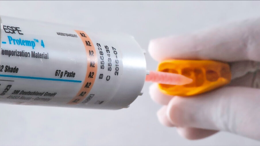 Fig. 4: Following tooth preparation, a temporary crown is produced chairside with 3M™ Protemp™ 4 Temporization Material. This material exhibits a high strength and a natural gloss without polishing.