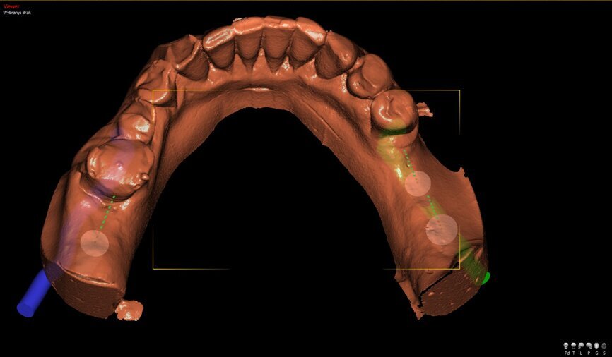 Ryc. 1_Wirtualne planowanie położenia wszczepów.