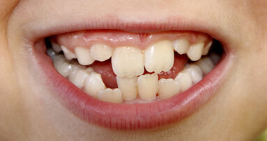 Frühkindlicher Stress führt zu schiefem Biss