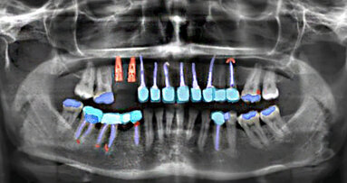 Artificial intelligence-based analysis of dental radiographs saves time in patient care