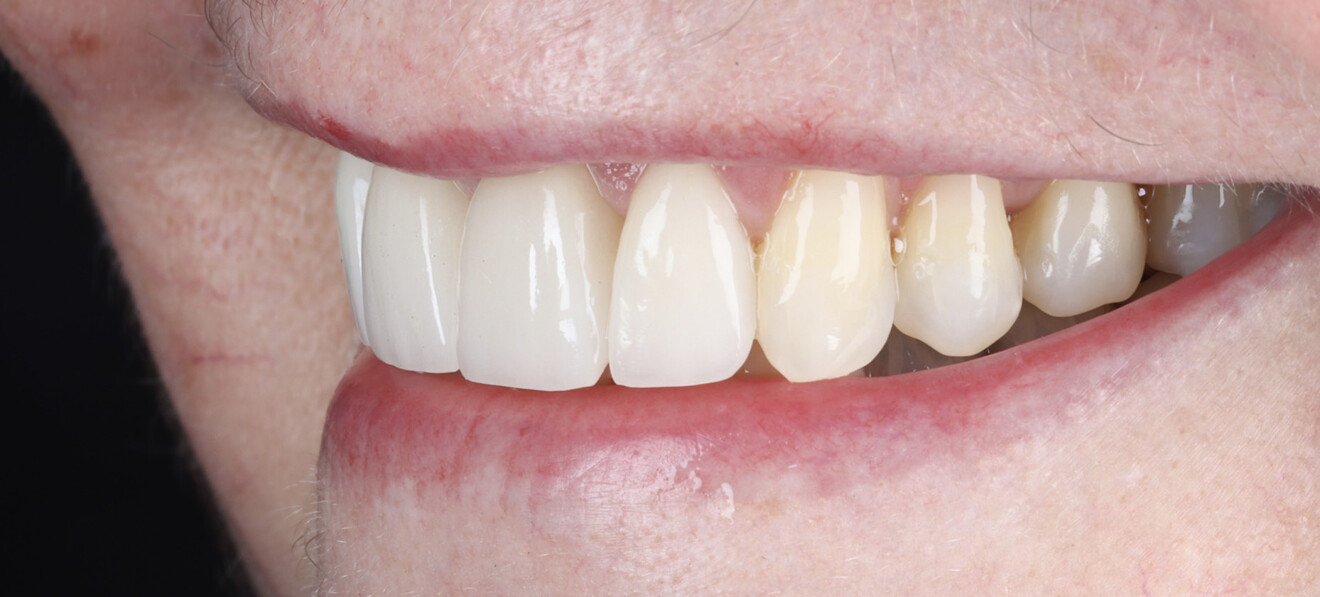 Fig. 24b: Lateral view from the left side. 