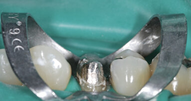 Retrouver l’accès aux canaux lors d’un retraitement