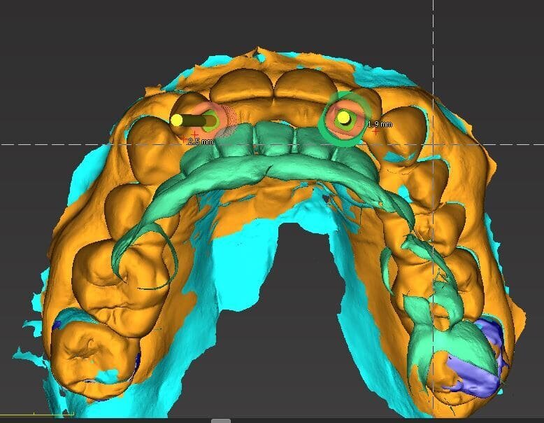 Fig. 15_Nella visione di centrica è possibile valorizzare il progetto di posizionamento che ha tenuto conto della disponibilità ossea per sfruttare al massimo l’osso nativo, la posizione degli incisivi laterali, il parallelismo implantare il foro di fissaggio all’interno del cingolo coronale per non compromettere la porzione estetica vestibolare.