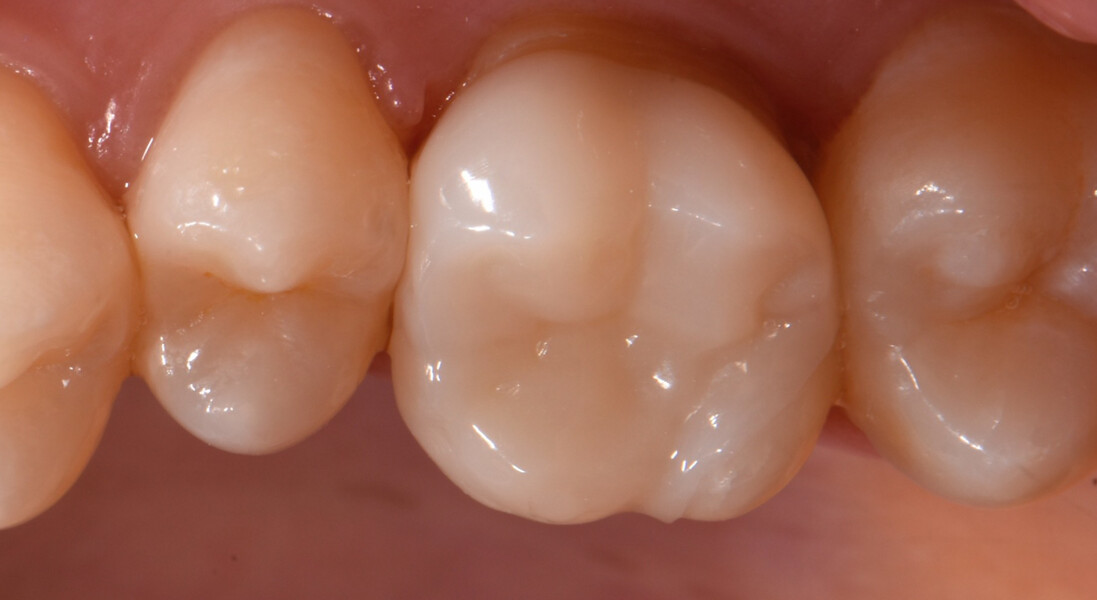 Fig. 18b: Onlay evaluated during the try-in, occlusal view.