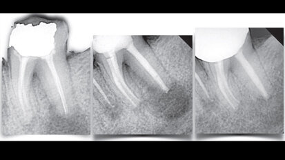 I ritrattamenti sono un modo unico per salvare non solo i denti ma anche l'osso circostante
