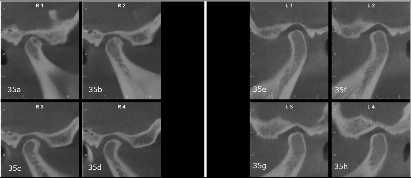 Figs. 35a–h: Pretreatment CBCT images of both temporomandibular joints (sagittal views). (a–d) Right. (e–h) Left.