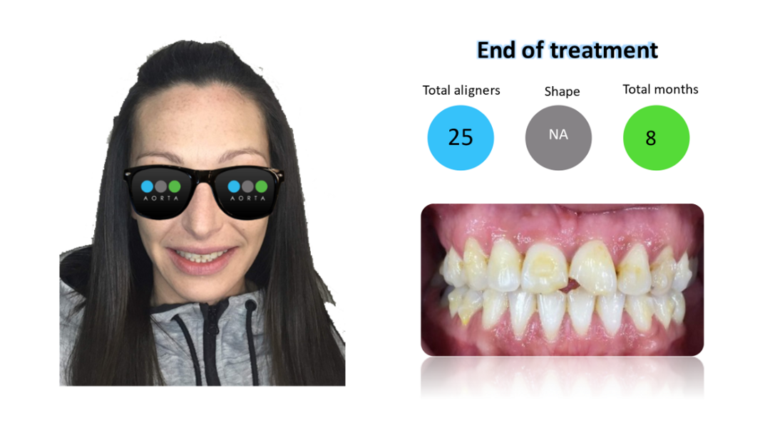 Fig. 35: Patient’s facial photograph after clear aligner treatment, alongside a close-up view of the patient’s smile.