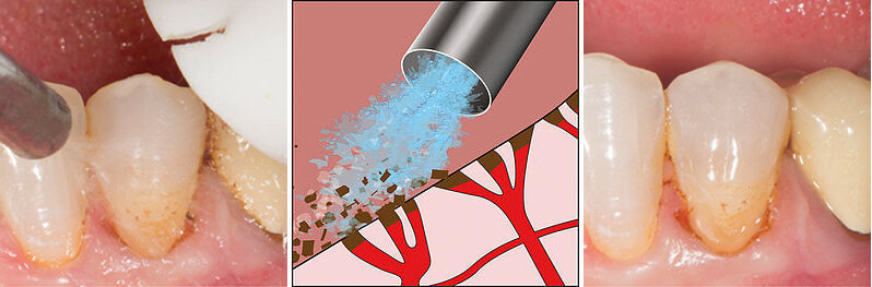 Fig 4. Vigorous washing effectively removes the loose coagulum that could mask slight bleeding underneath. The gingival margin is dried with the air/-water syringe and observed in case some localized bleeding still occurs, which and requires further scrubbing of the hemostatic agent. 