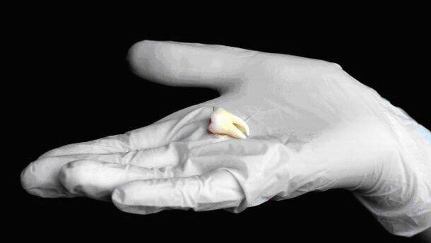 Nieuwe forensische tandentest maakt leeftijdsbepaling preciezer dan ooit