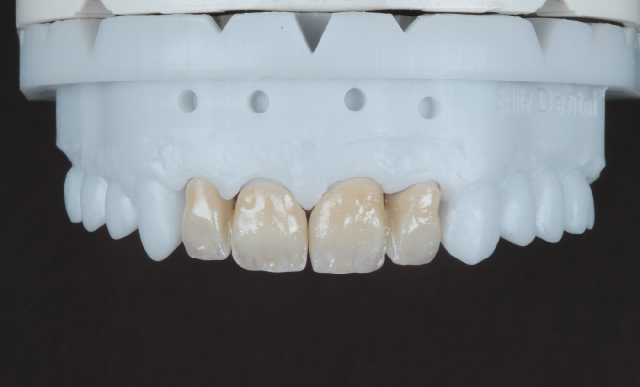 Fig. 7 : Restaurations sur le modèle après coloration interne qui a permis de créer les caractéristiques nécessaires à l’obtention d’un effet de profondeur naturel.
