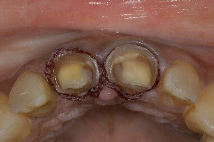 Fig 1: Horizontal margin geometry that requires preparation into dentin