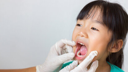 Sealed primary molars reduce caries risk Sealed primary molars reduce caries risk