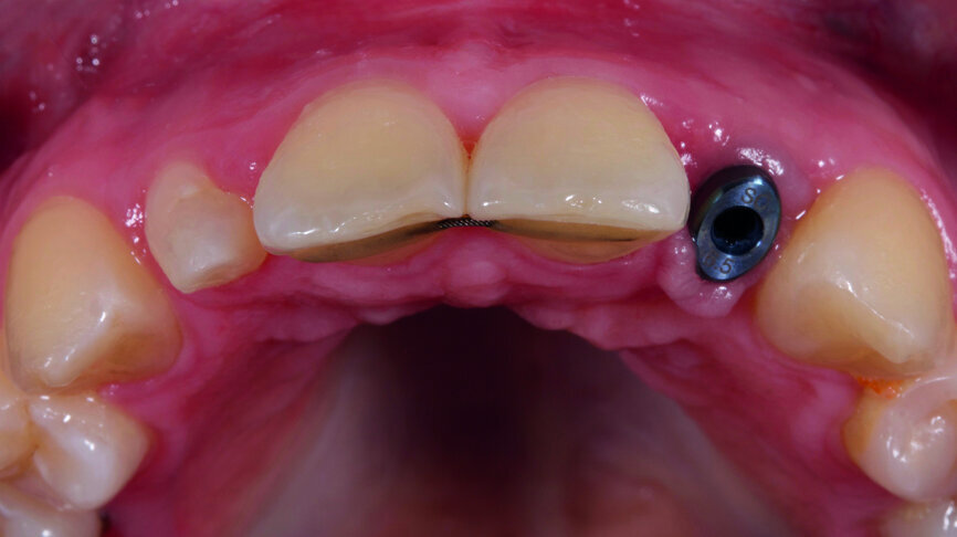 Fig. 6: Successful placement of the implant.