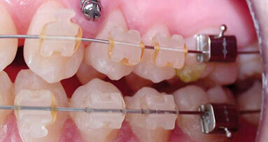 Parodontologisch-kieferorthopädische Behandlung Erwachsener