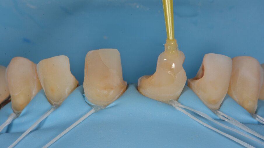 3MTM ScotchbondTM Universal adhesief werd gedurende 35 seconden aangebracht en vervolgens uitgehard. Na het etsen zien we duidelijk dat we door de minimale preparatie buccaal hoofdzakelijk aan glazuur kunnen binden.
